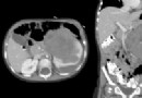 Mit dem Wilms-Tumor verbundenes Gen gibt Kindern mit seltenem Nierenkrebs Hoffnung 