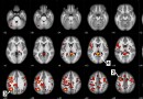 KI wird jetzt verwendet, um Anzeichen von Schizophrenie in Gehirnscans zu erkennen 